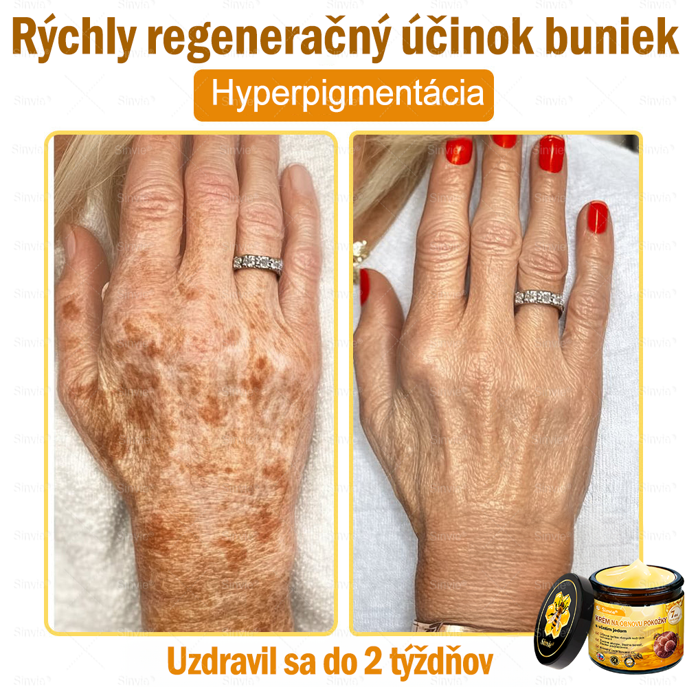 🌻 Sinvie® Krém na obnovu pokožky s včelím jedom 🔥 Odporúčané dermatológmi | Proti vráskam, pigmentovým škvrnám a ochabnutej pokožke – 50 ml