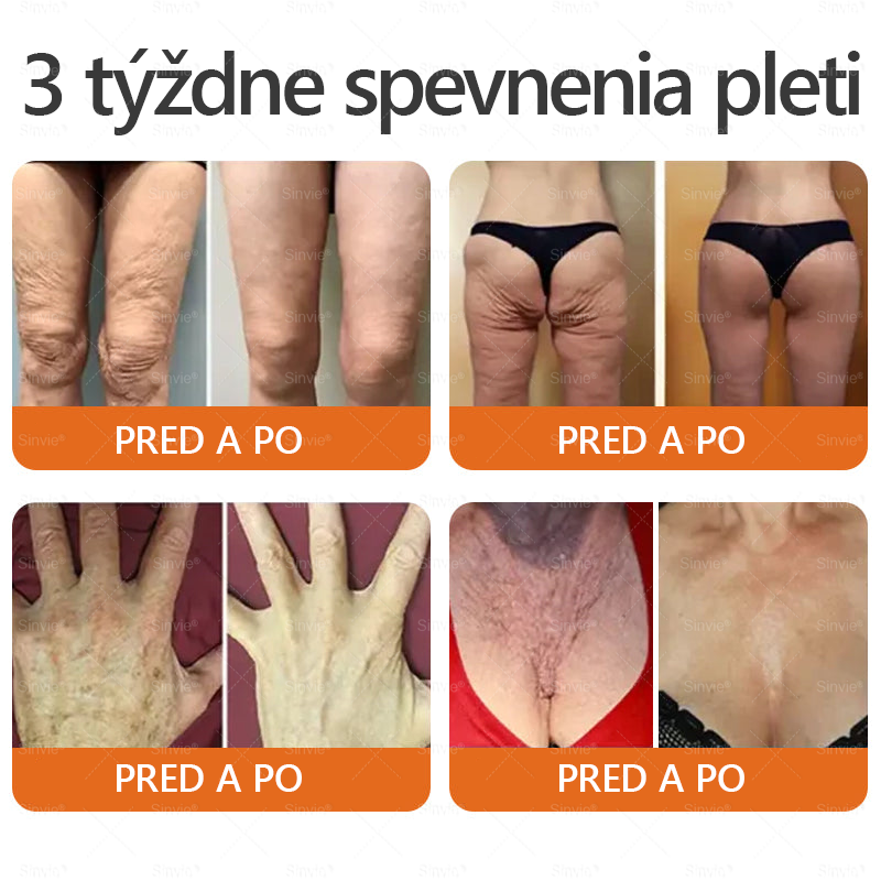 🌻 Sinvie® Krém na obnovu pokožky s včelím jedom 🔥 Odporúčané dermatológmi | Proti vráskam, pigmentovým škvrnám a ochabnutej pokožke – 50 ml