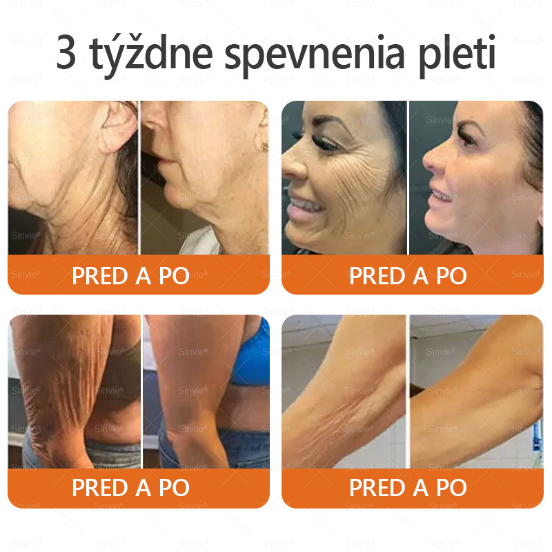 🌻 Sinvie® Krém na obnovu pokožky s včelím jedom 🔥 Odporúčané dermatológmi | Proti vráskam, pigmentovým škvrnám a ochabnutej pokožke – 50 ml