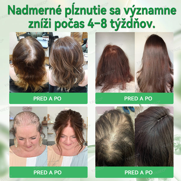 🍌𝐘𝐀𝐈𝐈𝐄𝐎® 𝑭á𝒋𝒅𝒂𝒍𝒐𝒎𝒎𝒆𝒏𝒕𝒆𝒔 𝑴𝒊𝒌𝒓𝒏💛 𝑹𝒆𝒏𝒅𝒔𝒛𝒆𝒓 Hlboko pôsobiace blokovanie DHT, reaktivácia vlasových folikulov a viditeľný rast vlasov