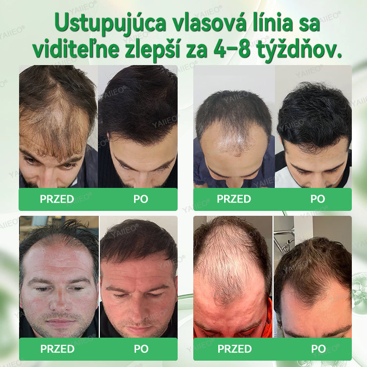 🍌𝐘𝐀𝐈𝐈𝐄𝐎® 𝑭á𝒋𝒅𝒂𝒍𝒐𝒎𝒎𝒆𝒏𝒕𝒆𝒔 𝑴𝒊𝒌𝒓𝒏💛 𝑹𝒆𝒏𝒅𝒔𝒛𝒆𝒓 Hlboko pôsobiace blokovanie DHT, reaktivácia vlasových folikulov a viditeľný rast vlasov