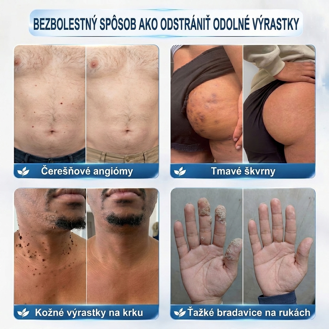 PuraCure® 👩‍⚕️ 7-dňové pero na odstraňovanie kožných výrastkov a znamienok – bezbolestný a bez jaziev, profesionálny valčekový aplikátor
