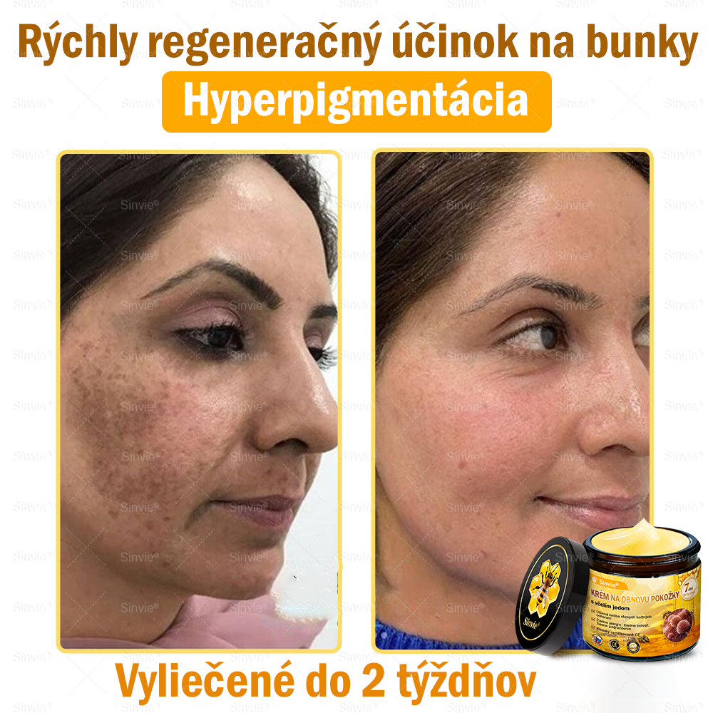 🌻 Sinvie® Krém na obnovu pokožky s včelím jedom 🔥 Odporúčané dermatológmi | Proti vráskam, pigmentovým škvrnám a ochabnutej pokožke – 50 ml